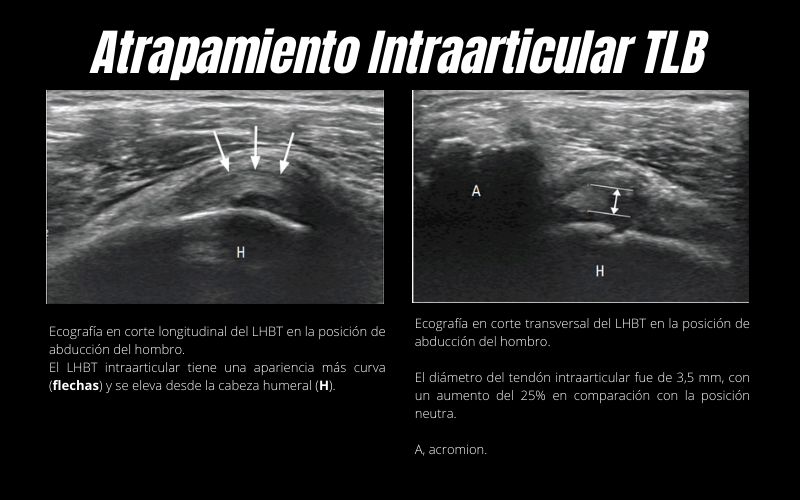 Atrapamiento Intraarticular Tendón Largo Bíceps Ecografía.png